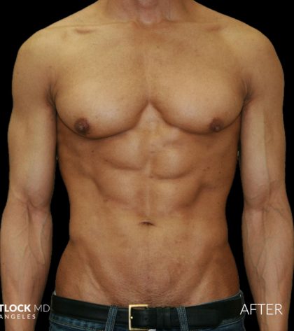 High Def Liposuction Male Before & After Patient #2735