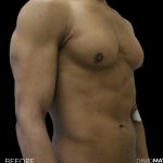 High Def Liposuction Male Before & After Patient #2735