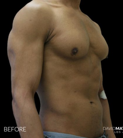High Def Liposuction Male Before & After Patient #2735