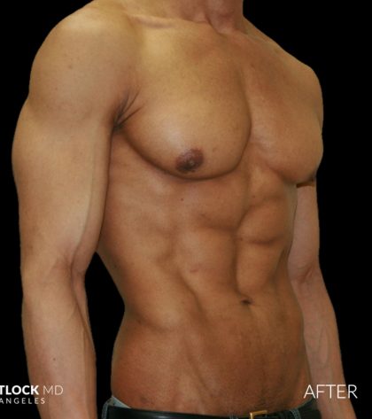 High Def Liposuction Male Before & After Patient #2735