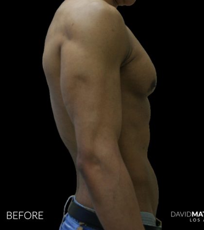 High Def Liposuction Male Before & After Patient #2735
