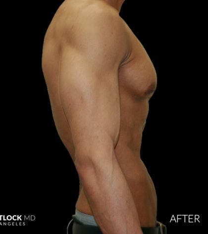 High Def Liposuction Male Before & After Patient #2735