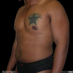 High Def Liposuction Male Before & After Patient #2736
