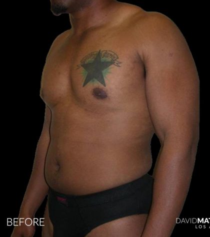 High Def Liposuction Male Before & After Patient #2736