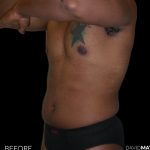 High Def Liposuction Male Before & After Patient #2736
