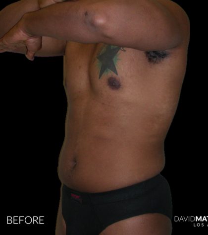 High Def Liposuction Male Before & After Patient #2736