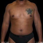 High Def Liposuction Male Before & After Patient #2736