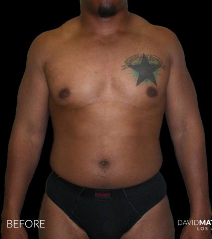 High Def Liposuction Male Before & After Patient #2736