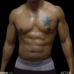 High Def Liposuction Male Before & After Patient #2736