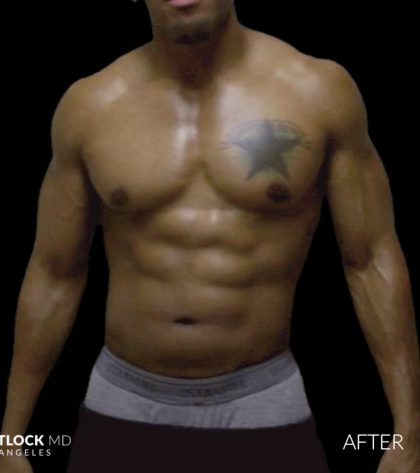 High Def Liposuction Male Before & After Patient #2736