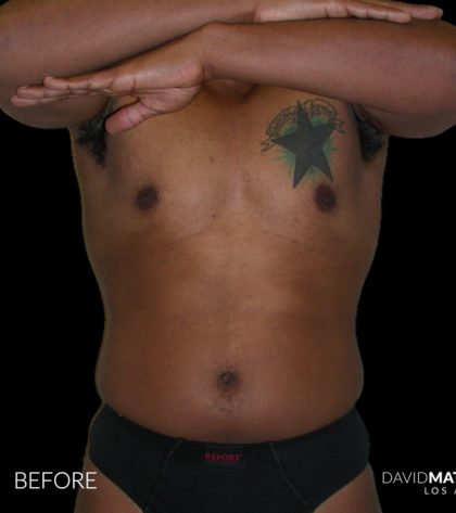 High Def Liposuction Male Before & After Patient #2736