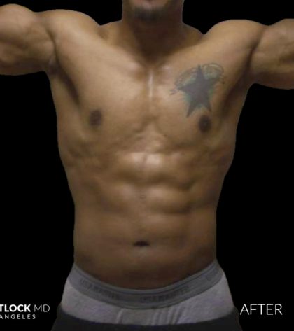 High Def Liposuction Male Before & After Patient #2736