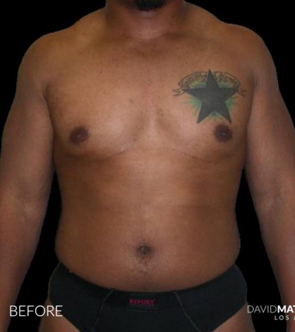 High Def Liposuction Male Before & After Patient #2736