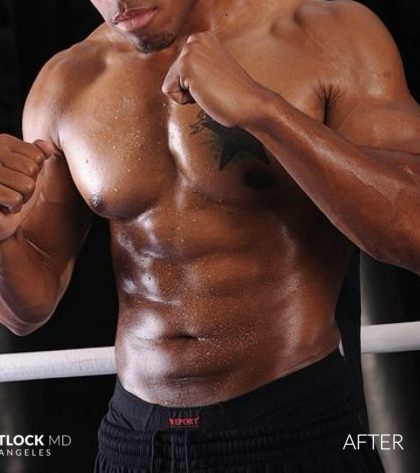 High Def Liposuction Male Before & After Patient #2736