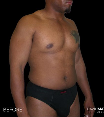 High Def Liposuction Male Before & After Patient #2736