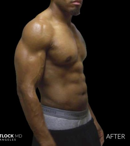 High Def Liposuction Male Before & After Patient #2736