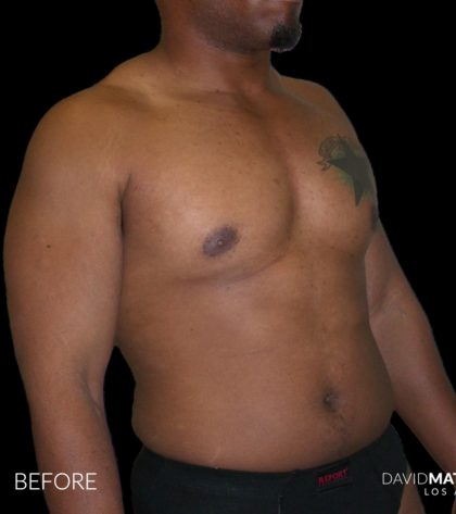 High Def Liposuction Male Before & After Patient #2736