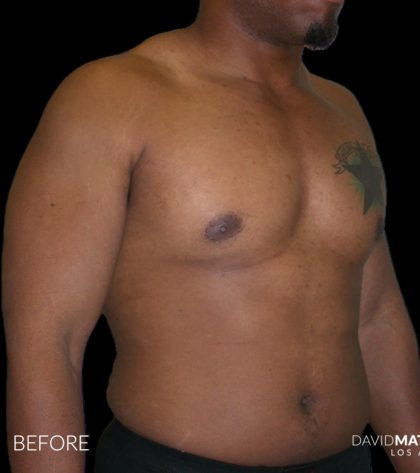 High Def Liposuction Male Before & After Patient #2736