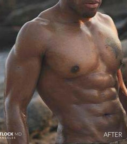 High Def Liposuction Male Before & After Patient #2736