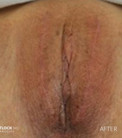 Labia Majora Before & After Patient #2772