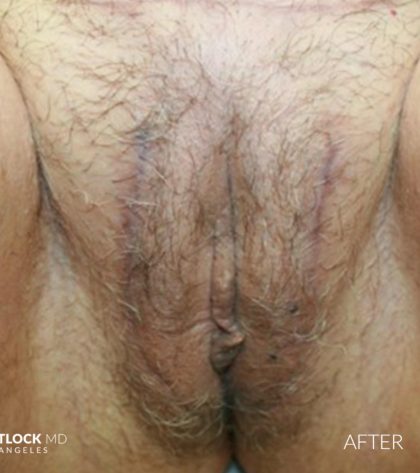 Labia Majora Before & After Patient #2774