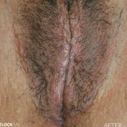 Labia Majora Augmentation Before & After Patient #2771