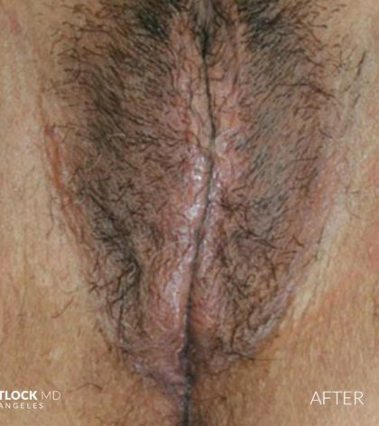 Labia Majora Augmentation Before & After Patient #2771