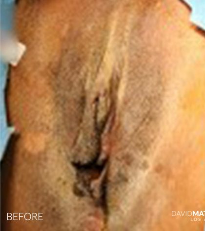 Labia Minora Before & After Patient #2787