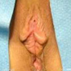 Labia Minora Before & After Patient #2789