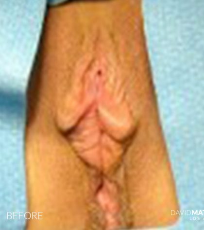 Labia Minora Before & After Patient #2789