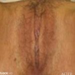 Labia Minora Before & After Patient #2789