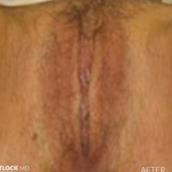 Labia Minora Before & After Patient #2789