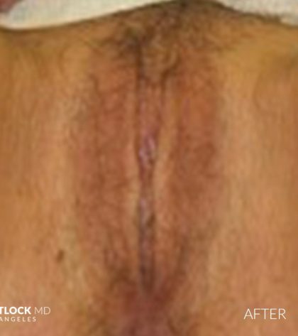 Labia Minora Before & After Patient #2789