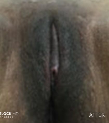 Labia Minora Before & After Patient #2790