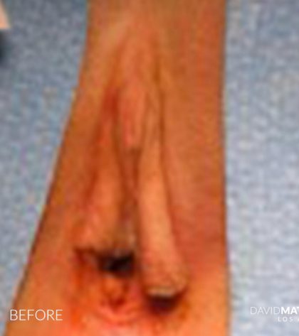 Labia Minora Before & After Patient #2792