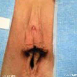 Labia Minora Before & After Patient #2794