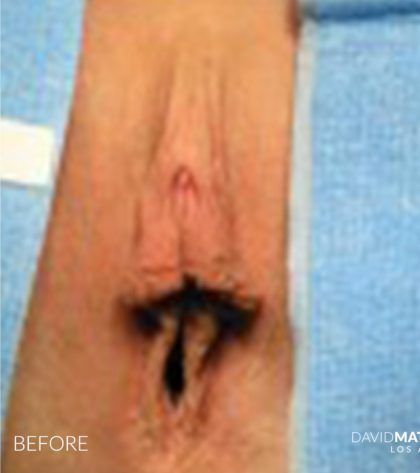 Labia Minora Before & After Patient #2794