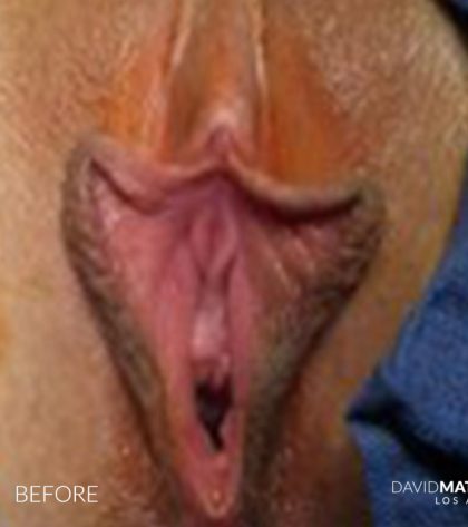 Labia Minora Before & After Patient #2796