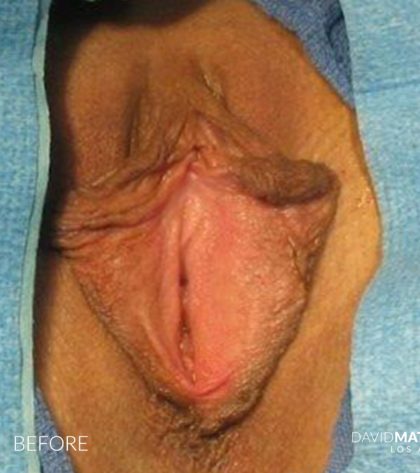 Labia Minora Before & After Patient #2797