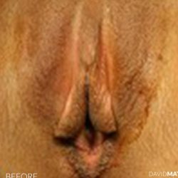 Labia Minora Before & After Patient #2798
