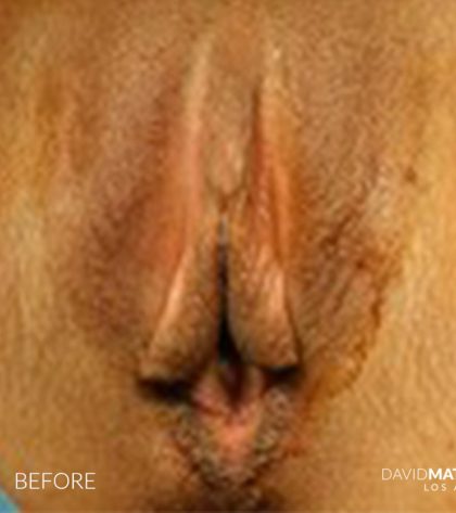 Labia Minora Before & After Patient #2798