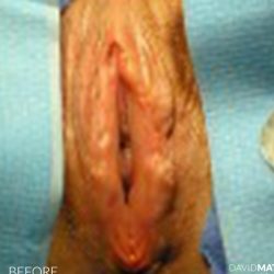 Labia Minora Before & After Patient #2800