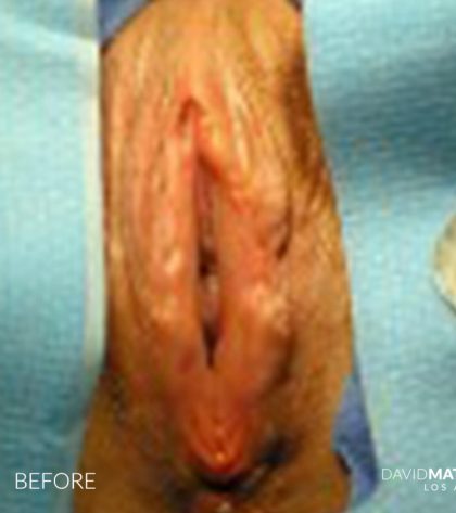 Labia Minora Before & After Patient #2800