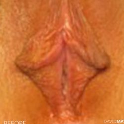 Labia Minora Before & After Patient #2802