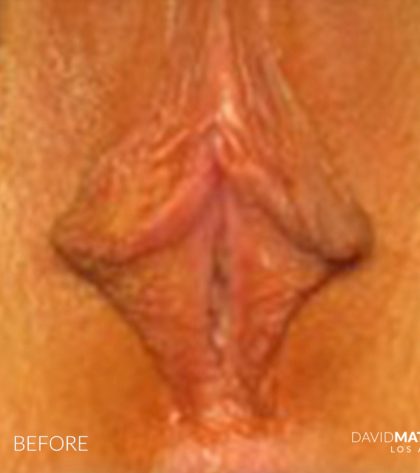 Labia Minora Before & After Patient #2802