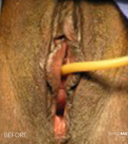 Labia Minora Before & After Patient #2779