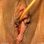 Labia Minora Before & After Patient #2780