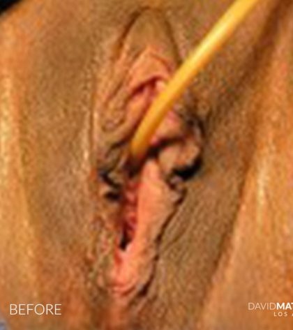 Labia Minora Before & After Patient #2780