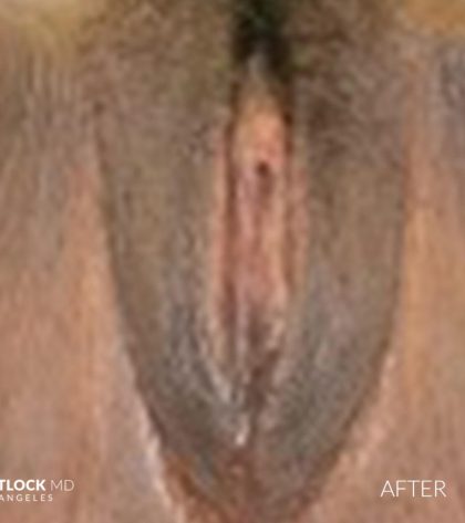 Labia Minora Before & After Patient #2780