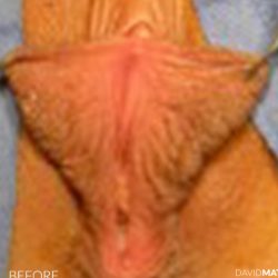 Labia Minora Before & After Patient #2782
